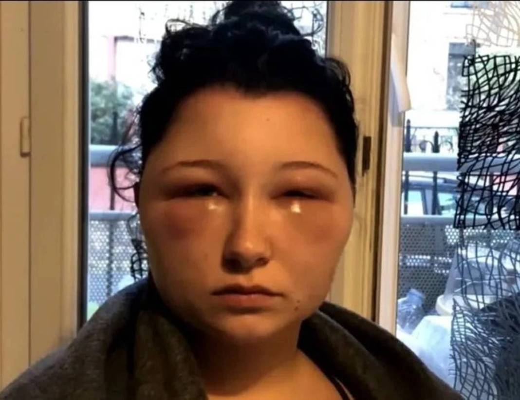 Marketten aldığı ürünle saçını boyadı: Kafası ampul gibi şişti! Yakınları bile tanıyamadı 5